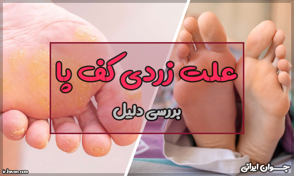 علت زردی کف پا چیست؟ چه زمانی به پزشک مراجعه کنیم؟ - جوان ایرانی