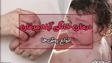 درمان خانگی آبله مرغان
