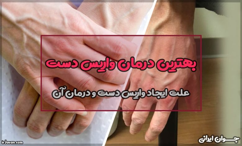 بهترین درمان واریس دست