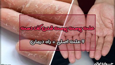علت پوست پوست شدن کف دست