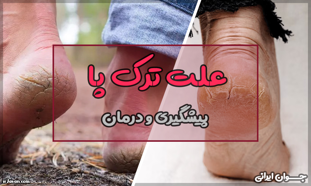 علت ترک پا (درمان ترک پاشنه پا و روشهای خانگی پیشگیری) - جوان ایرانی