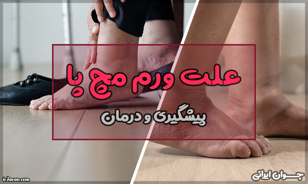 علت ورم مچ پا (دلایل، درمان و پیشگیری از ورم پا) - جوان ایرانی