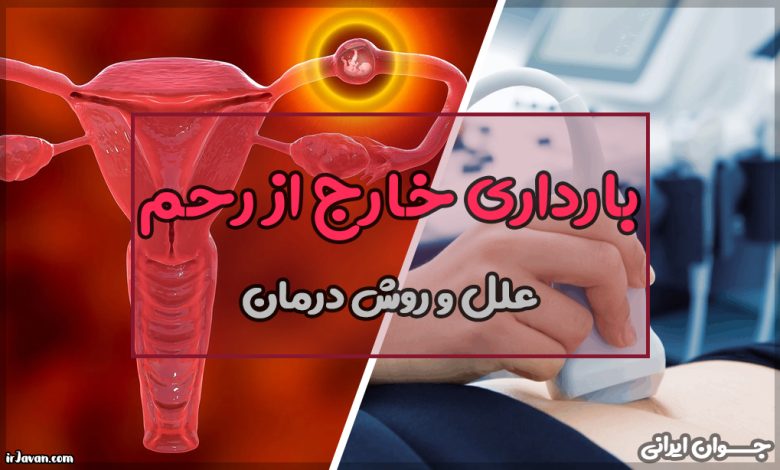 بارداری خارج از رحم