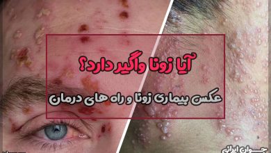 آیا زونا واگیر دارد