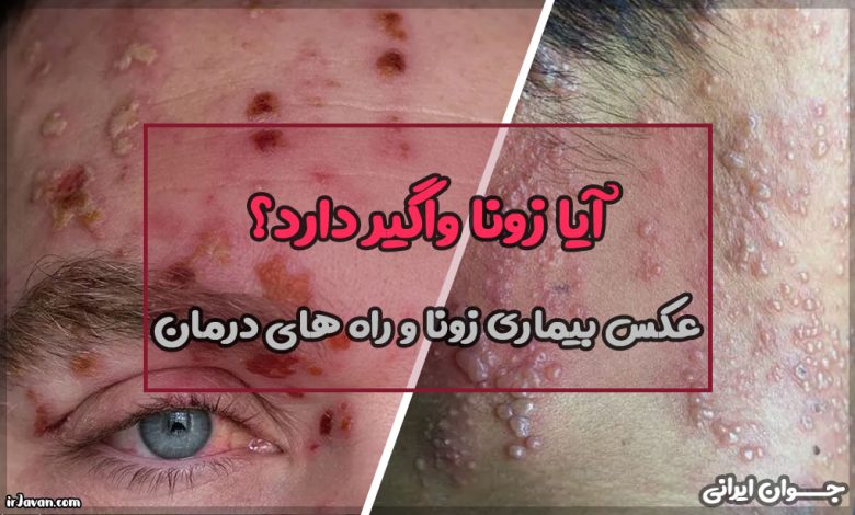 آیا زونا واگیر دارد