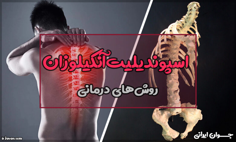 بیماری as اسپوندیلیت آنکیلوزان چیست؟